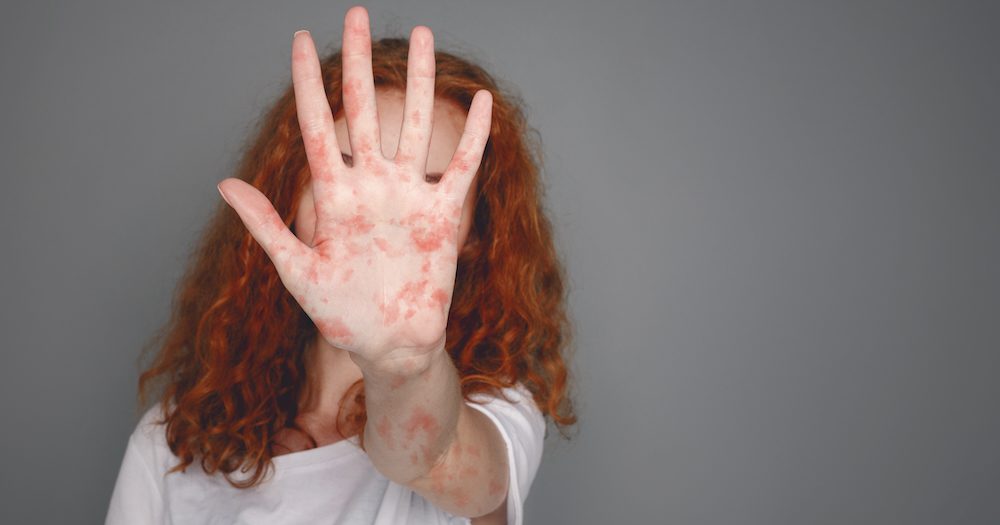 Measles warning as travellers bring disease to Australia & Europe records 3,000+% rise in cases